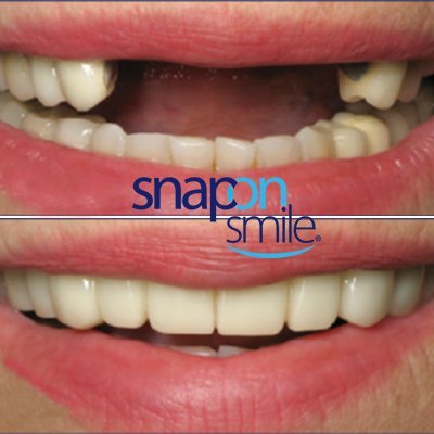 snap-on-smile-img1-1.jpg